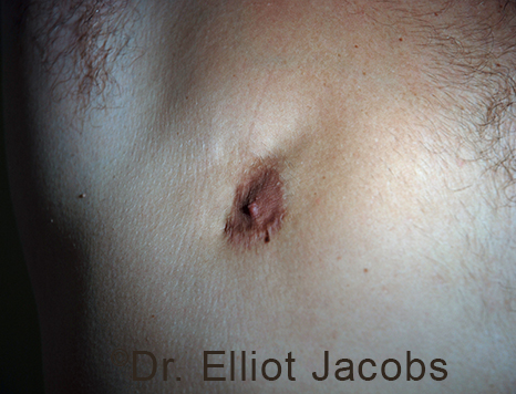 Men's nipple, before Revision Gynecomastia treatment, front view - patient 3