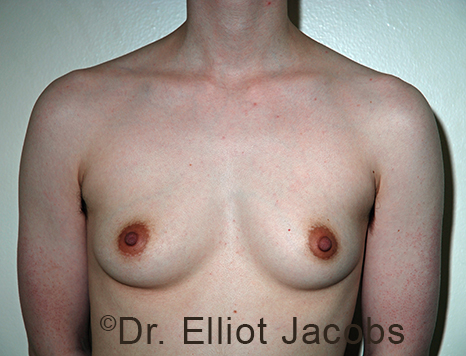 Gynecomastia. Male breast, before FTM Top Surgery treatment, front view, patient 18