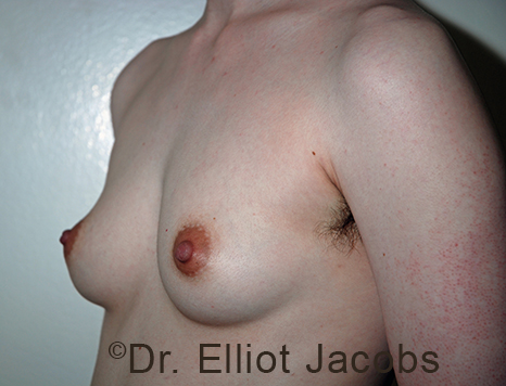 Gynecomastia. Male breast, before FTM Top Surgery treatment, l-side oblique view, patient 18