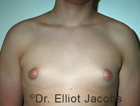 Men's breast, before Gynecomastia Adolescent treatment, front view - patient 38