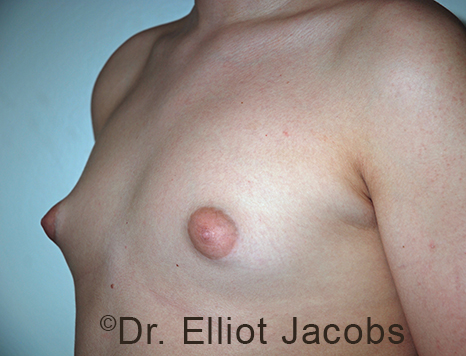 Men's breast, before Gynecomastia Adolescent treatment, oblique view - patient 38