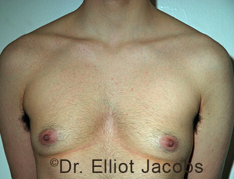 Gynecomastia. Male breast, before FTM Top Surgery treatment, front view, patient 19