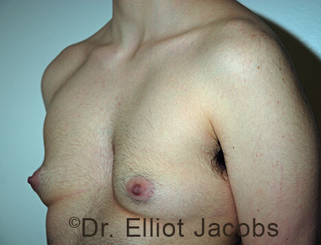 Gynecomastia. Male breast, before FTM Top Surgery treatment, l-side oblique view, patient 19