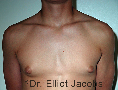Men's breast, before Gynecomastia Adolescent treatment, front view - patient 39