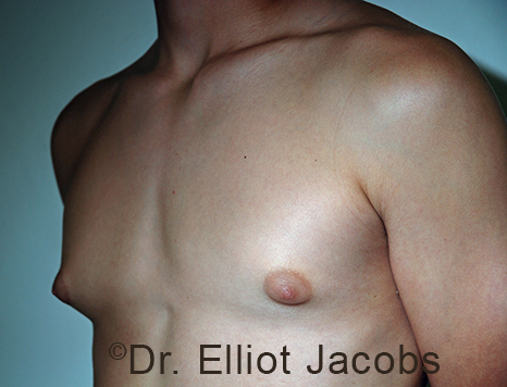Men's breast, before Gynecomastia Adolescent treatment, oblique view - patient 39