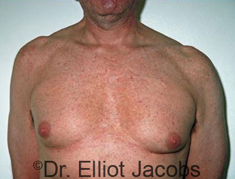 Male breast, before Gynecomastia treatment, front view, patient 31
