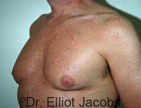Male breast, before Gynecomastia treatment, l-side oblique view - patient 31