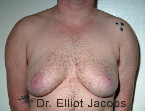 Gynecomastia. Male breast, before FTM Top Surgery treatment, front view, patient 20