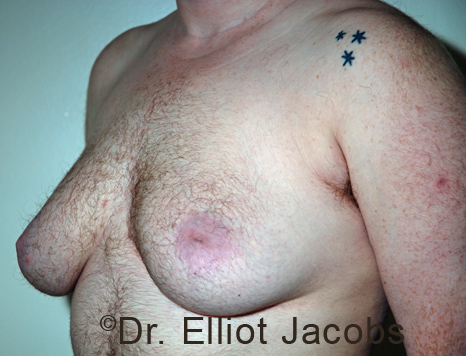 Gynecomastia. Male breast, before FTM Top Surgery treatment, l-side oblique view, patient 20