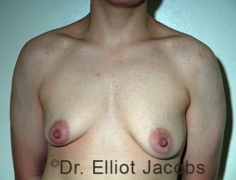 Gynecomastia. Male breast, before FTM Top Surgery treatment, front view, patient 24