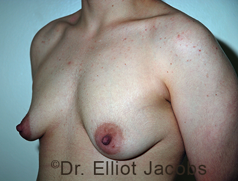 Gynecomastia. Male breast, before FTM Top Surgery treatment, l-side oblique view, patient 24