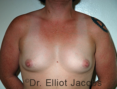 Gynecomastia. Male breast, before FTM Top Surgery treatment, front view, patient 21