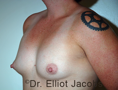 Gynecomastia. Male breast, before FTM Top Surgery treatment, l-side oblique view, patient 21