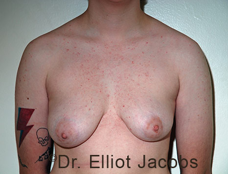 Gynecomastia. Male breast, before FTM Top Surgery treatment, front view, patient 22