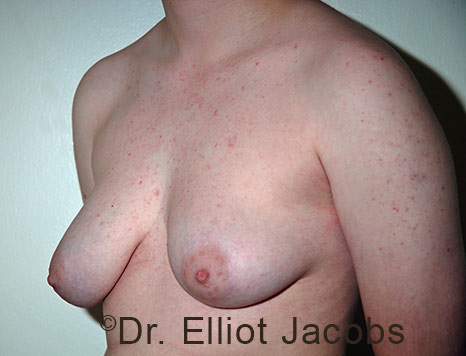 Gynecomastia. Male breast, before FTM Top Surgery treatment, l-side oblique view, patient 22