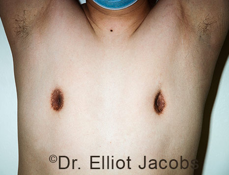 Men's breast, before Crater Deformity Repair treatment, front view - patient 6