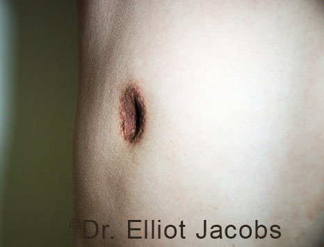 Men's breast, before Crater Deformity Repair treatment, front view, patient 6
