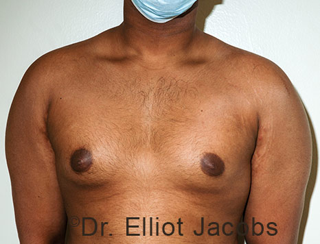 Male breast, before Gynecomastia treatment, front view, patient 110