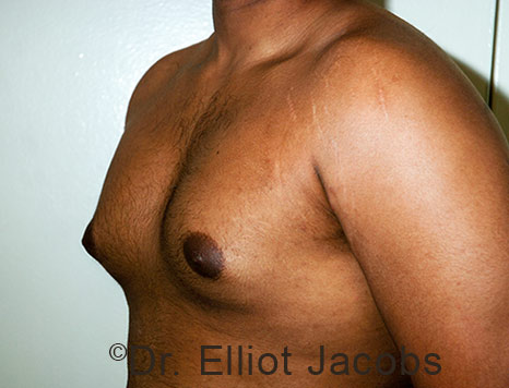 Male breast, before Gynecomastia treatment, l-side oblique view - patient 110