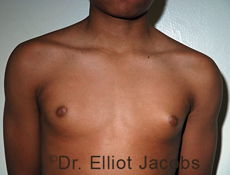 Men's breast, before Gynecomastia Adolescent treatment, front view - patient 40