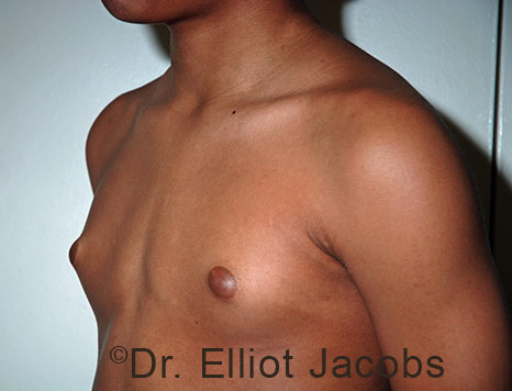 Men's breast, before Gynecomastia Adolescent treatment, oblique view - patient 40