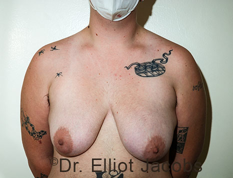 Gynecomastia. Male breast, before FTM Top Surgery treatment, front view, patient 23