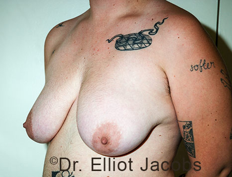 Gynecomastia. Male breast, before FTM Top Surgery treatment, l-side oblique view, patient 23