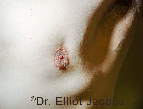 Men's breast, before Crater Deformity Repair treatment, front view - patient 7
