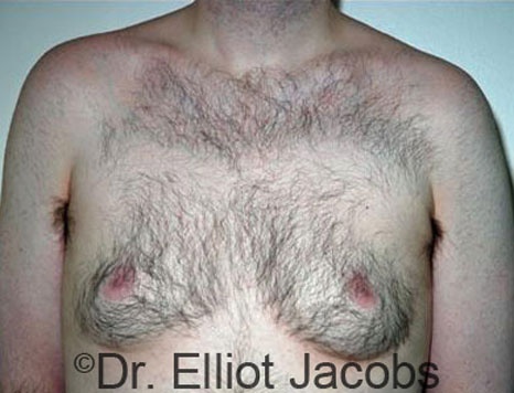 Male breast, before Gynecomastia treatment, front view, patient 32