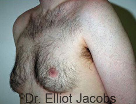 Male breast, before Gynecomastia treatment, l-side oblique view - patient 32
