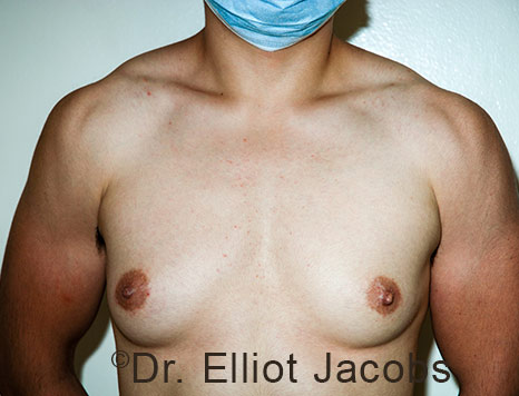 Gynecomastia. Male breast, before FTM Top Surgery treatment, front view, patient 25