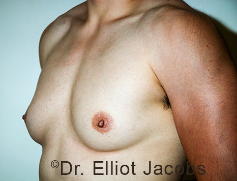 Gynecomastia. Male breast, before FTM Top Surgery treatment, l-side oblique view, patient 25
