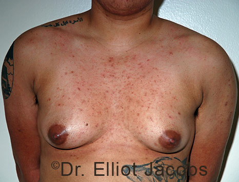 Gynecomastia. Male breast, before FTM Top Surgery treatment, front view, patient 26