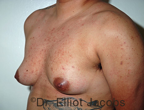 Gynecomastia. Male breast, before FTM Top Surgery treatment, l-side oblique view, patient 26