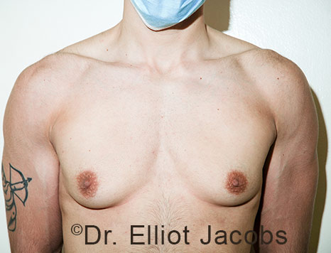 Gynecomastia. Male breast, before FTM Top Surgery treatment, front view, patient 27