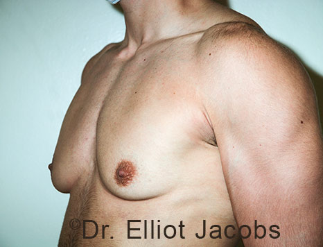 Gynecomastia. Male breast, before FTM Top Surgery treatment, l-side oblique view, patient 27