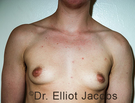 Gynecomastia. Male breast, before FTM Top Surgery treatment, front view, patient 28