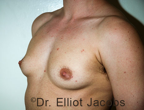 Gynecomastia. Male breast, before FTM Top Surgery treatment, l-side oblique view, patient 28