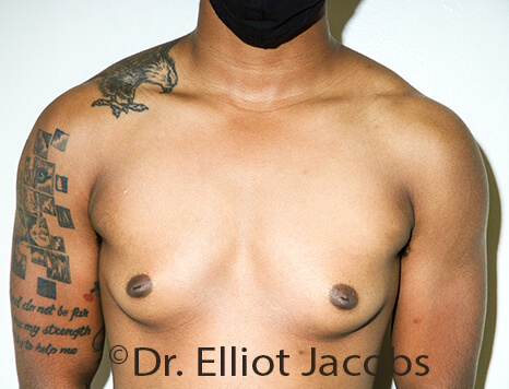 Gynecomastia. Male breast, before FTM Top Surgery treatment, front view, patient 29