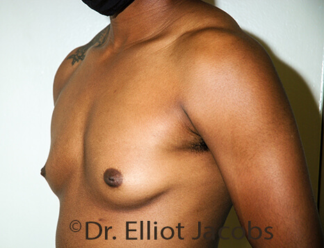 Gynecomastia. Male breast, before FTM Top Surgery treatment, l-side oblique view, patient 29