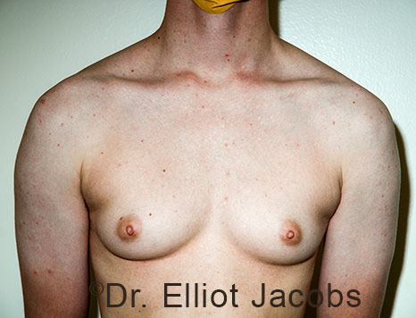 Gynecomastia. Male breast, before FTM Top Surgery treatment, front view, patient 30