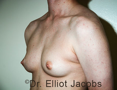 Gynecomastia. Male breast, before FTM Top Surgery treatment, l-side oblique view, patient 30