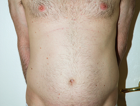 Male body, before Torsoplasty treatment, front view, patient 34