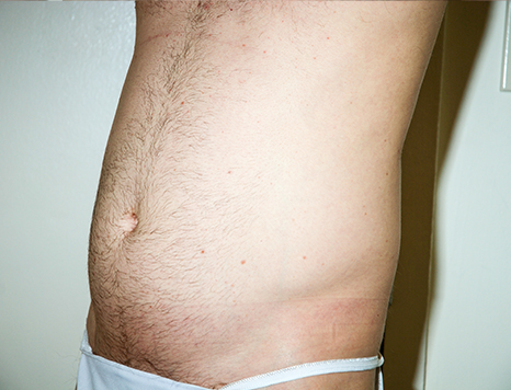 Male body, before Torsoplasty treatment, l-side oblique view, patient 34