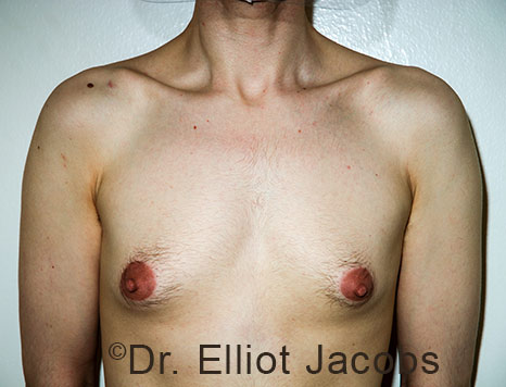 Male breast, before Gynecomastia treatment, front view, patient 111