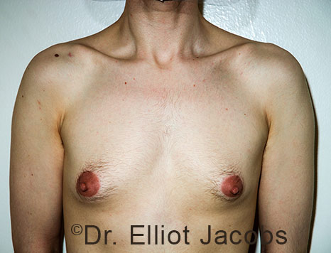 Gynecomastia. Male breast, before FTM Top Surgery treatment, front view, patient 31