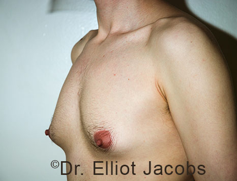 Gynecomastia. Male breast, before FTM Top Surgery treatment, l-side oblique view, patient 31