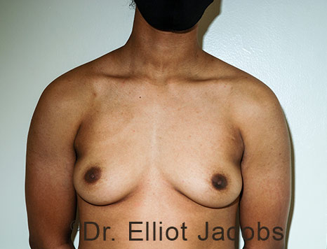 Gynecomastia. Male breast, before FTM Top Surgery treatment, front view, patient 32