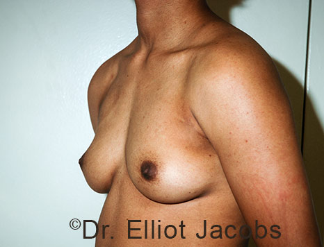 Gynecomastia. Male breast, before FTM Top Surgery treatment, l-side oblique view, patient 32