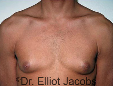 Male breast, before Gynecomastia treatment, front view, patient 33